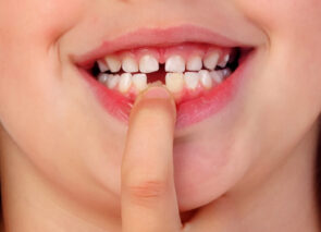 ילדה עם שן חסרה