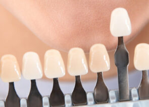 ציפויי שיניים